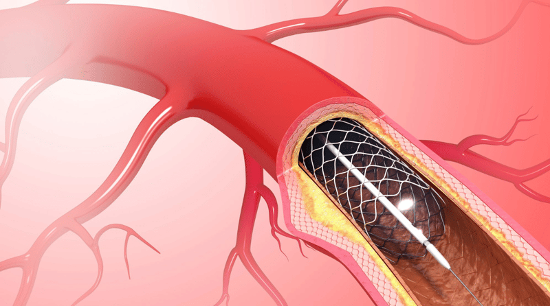 aligned bio blog  nanotechnology coronary disease